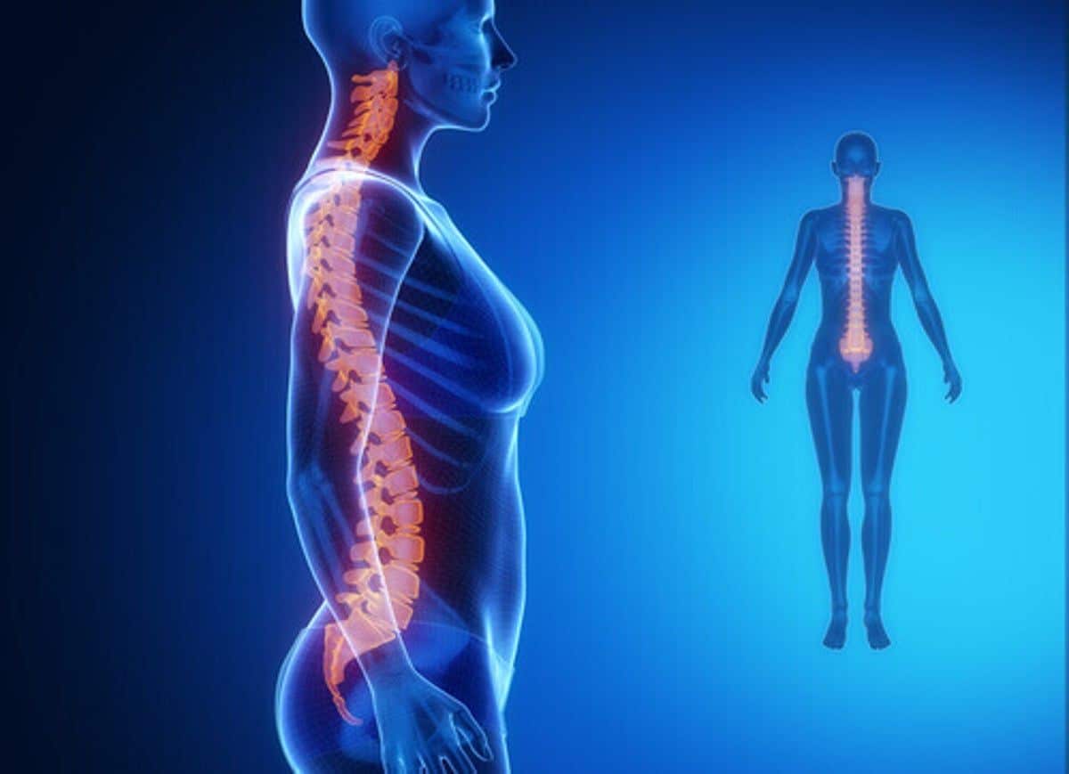 Artrosis de columna: qué es, síntomas y tratamiento