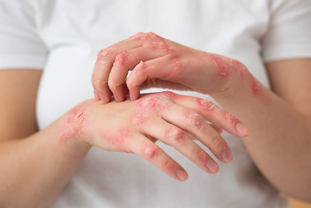 artritis psoriásica manos