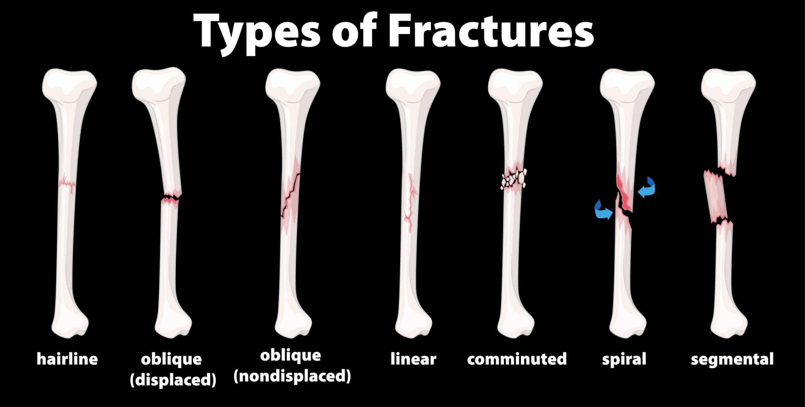 fractura humero