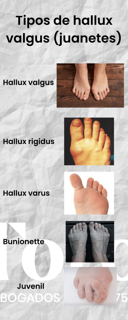 Tipos de hallux valgus (juanetes)