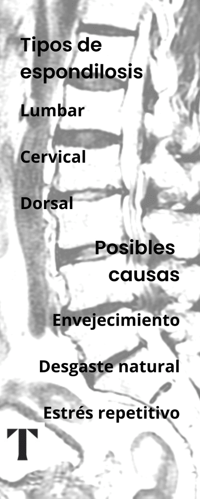espondilosis