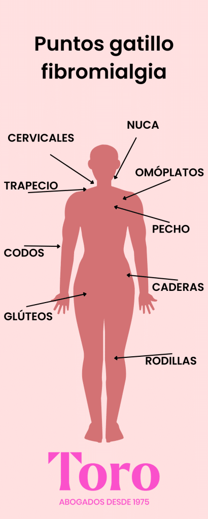 puntos gatillo fibromialgia