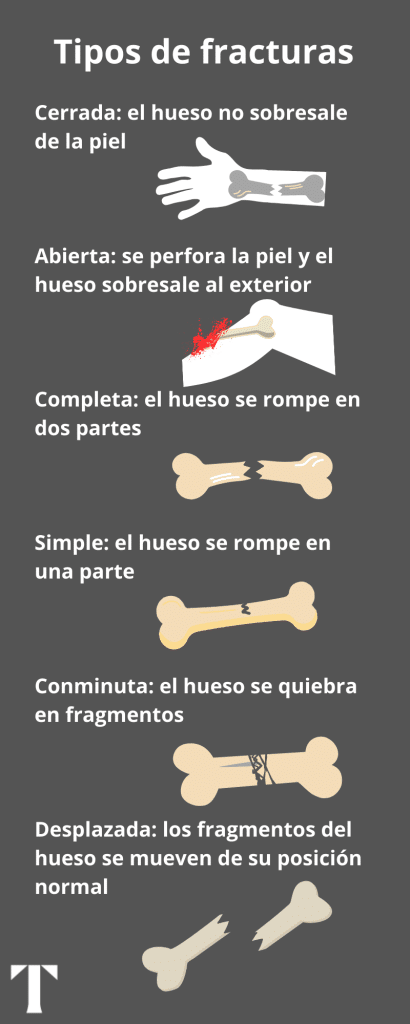 tipos de fracturas